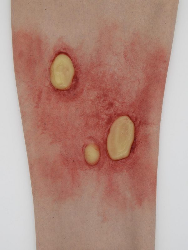 Burns and Blisters Kit - Bilde 5